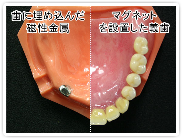 磁性アタッチメント義歯