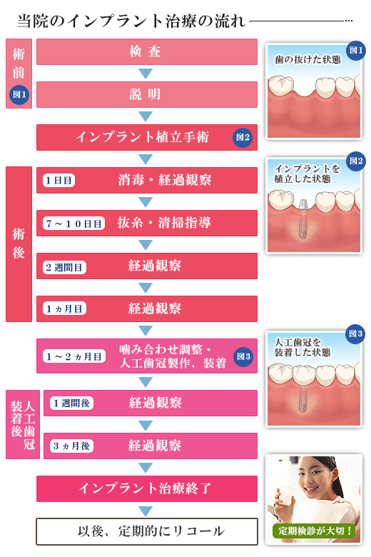 当院では、ＡＱＢインプラントを使用しています。