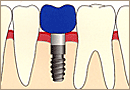 インプラントによる治療