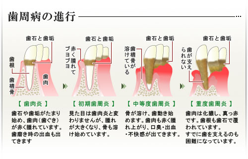 歯周病の進行