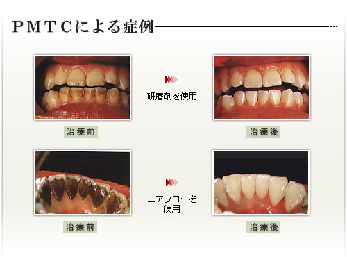 ＰＭＴＣによる症例