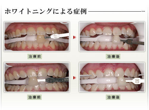 ホワイトニングによる症例